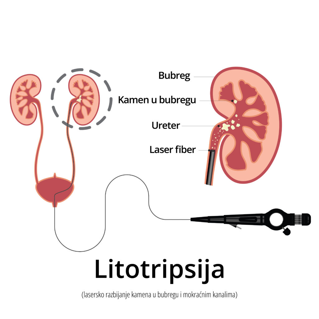 Lasersko razbijanje kamena u bubregu i mokracnim kanalima